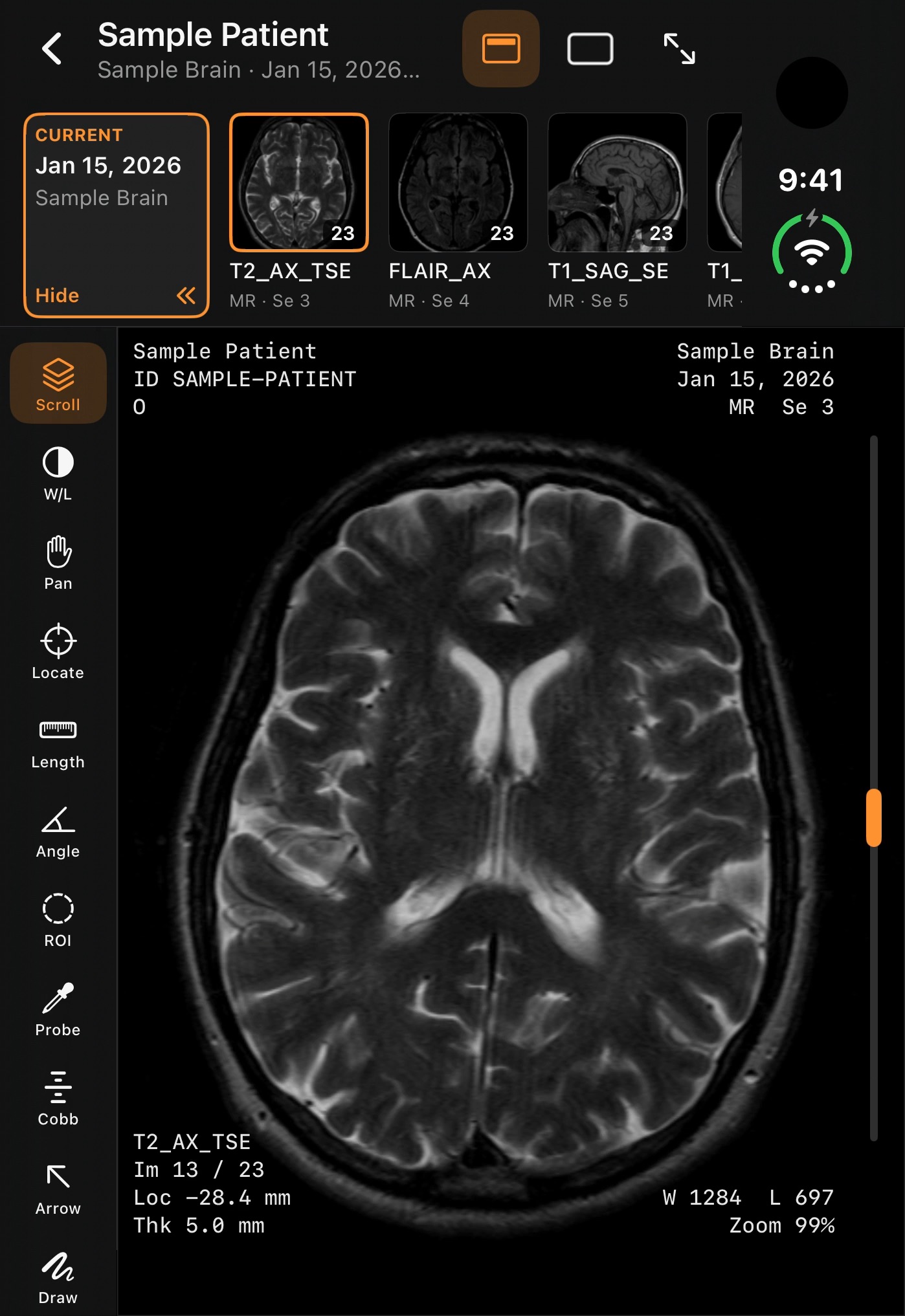 A sample brain MRI open on a phone
