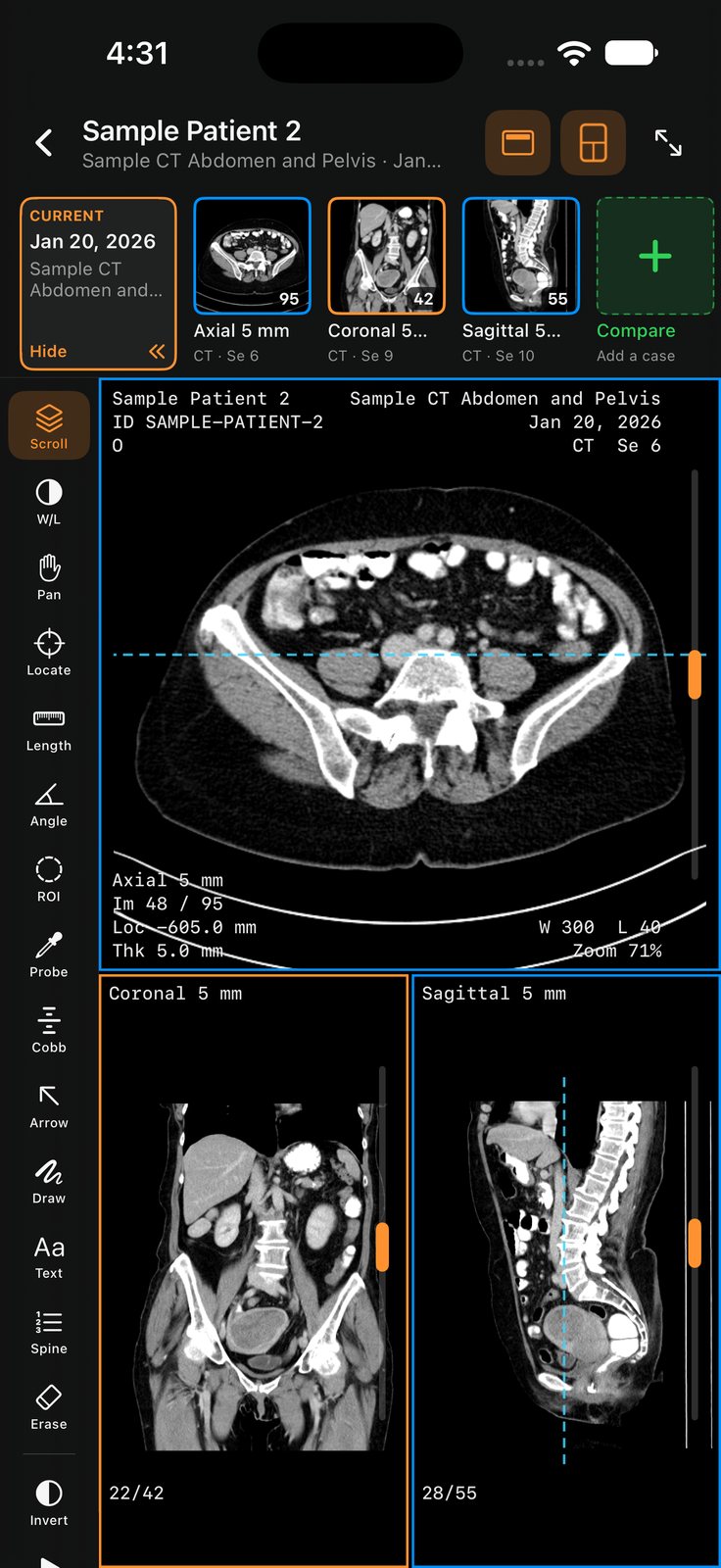 A sample CT of the abdomen open on iPhone